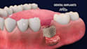oral cgi 3d cgi medical animation 3d explainer video  high quality dental medica