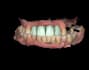 design crown and bridge using exocad