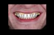 design dental waxup dsd using exocad