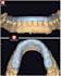 design a precise bite splint , night guard in exocad  stl ready