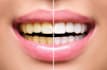 make your teeth whiter and your smile look natural