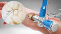 make 3d medical animation, medical device explainer, 3d surgery animation