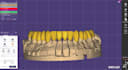 design crown and bridge using exocad