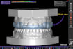 design dental splints in exocad ready for 3d printing