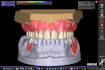 design digital total prostheses using exocad