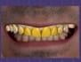 design a dental mock up design using exocad