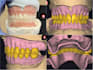 designe a professional full denture on exocad with high quality