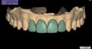 create esthetic veneer designs and dsd in exocad
