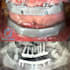 design ibars and gingivectomy guides using b4d and exocad