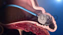 do 3d medical device animation catheter heart implant anatomy surgery explainer