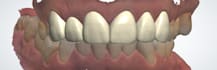 design highly precise perfect dental fixed prothesis using  3shape