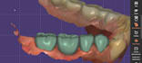 create accurate crowns and bridges using exocad
