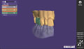 design dental crowns and bridges using exocad