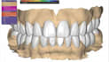 design dental digital projects exocad, 3shape, blender
