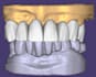 design dental crowns, bridges and implants using exocad