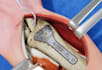 4k 3d medical surgery and device explainer animation video