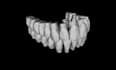 design unique crystal style teeth and crowns using exocad