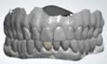 design crown, bridge, rpd, dentures and wax up using 3shape software