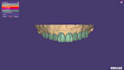 design crowns, bridges, using exocad