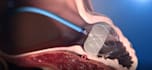 create 3d medical surgery procedure  human body anatomy animation