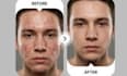 remove acne and spots from your images within 24 hours