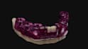 design precise surgical guide