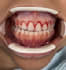 design precise gingivectomy guide