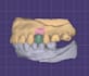 design crown and bridges in exocad