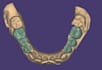 design dental crown and bridge using exocad
