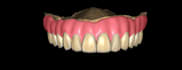 deisgn dental removable dentures