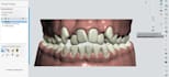 custom aligner treatment plans with 3d clincheck