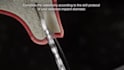 do 3d dental implant animation cosmetic surgical procedure explainer video ads