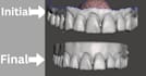 clear bleaching trays and mash stls