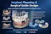 do professional implant planning and surgical guides