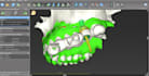 design custom dental implant surgical guide