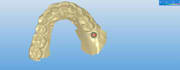 do exocad dental implant design fast and accurately
