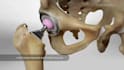 3d medical animation, surgery explainer video, medical device pharmaceutic moa