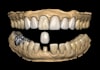 do dental prosthesis crown design using exocad, 3shape, inlab and cerec