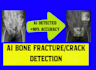 build ai bone fracture detection system with web interface
