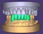 dental cad crown and implant design