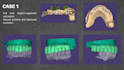 design dental cad crowns, bridges and implants using exocad