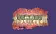 design dental crowns, bridges, veneers, and implants using exocad