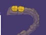 dental crown design exocad