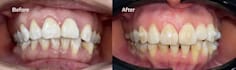 make accurate clear aligner setups with 3shape