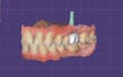 do expert dental designs on exocad