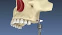 create realistic 3d dental implant animation and dental surgery animation