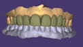 do expert digital dental design on exocade for veneers