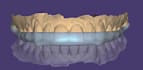do dental cad design for splints in exocad