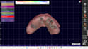 design full arch all on x prosthesis