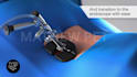 create 3d medical device animation surgical visualization and product demo